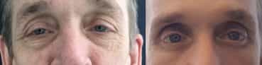 before and after Eyelid Surgery Colombia - Premium Care Plastic Surgery