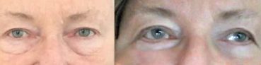 before and after Eyelid Surgery Colombia - Premium Care Plastic Surgery