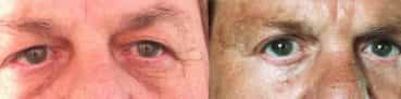 before and after Eyelid Surgery Colombia - Premium Care Plastic Surgery