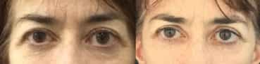before and after Eyelid Surgery Colombia - Premium Care Plastic Surgery
