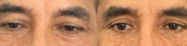 before and after Eyelid Surgery Colombia - Premium Care Plastic Surgery