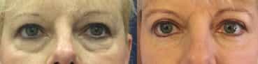 before and after Eyelid Surgery Colombia - Premium Care Plastic Surgery