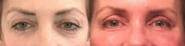 before and after Eyelid Surgery Colombia - Premium Care Plastic Surgery