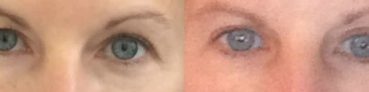 before and after Eyelid Surgery Colombia - Premium Care Plastic Surgery