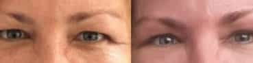 before and after Eyelid Surgery Colombia - Premium Care Plastic Surgery