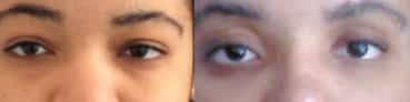 before and after Eyelid Surgery Colombia - Premium Care Plastic Surgery