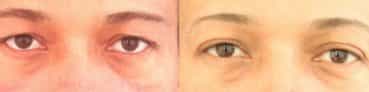 before and after Eyelid Surgery Colombia - Premium Care Plastic Surgery