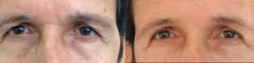 before and after Eyelid Surgery Colombia - Premium Care Plastic Surgery