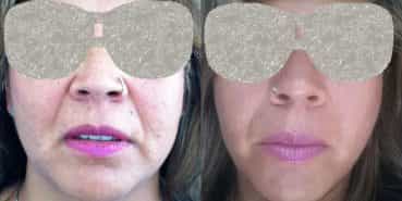 Facelift Colombia - Premium Care Plastic Surgery