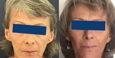 Facelift Colombia - Premium Care Plastic Surgery