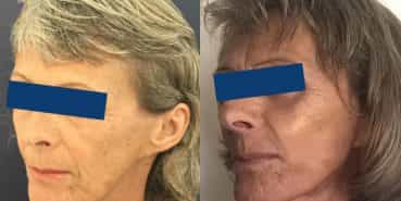 Facelift Colombia - Premium Care Plastic Surgery