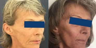 Facelift Colombia - Premium Care Plastic Surgery