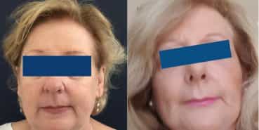 Before and After Facelift Colombia - Premium Care Plastic Surgery