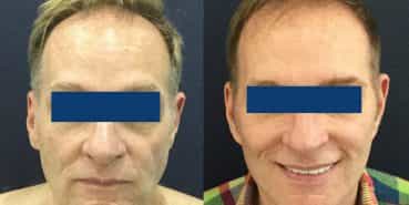 Facelift Colombia - Premium Care Plastic Surgery