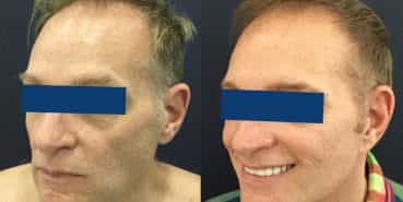 Facelift Colombia - Premium Care Plastic Surgery