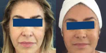 Before and After Facelift Colombia - Premium Care Plastic Surgery