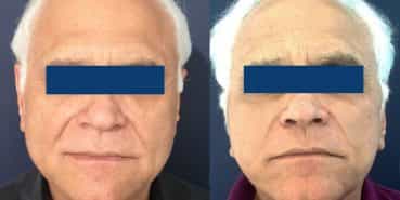 Facelift Colombia - Premium Care Plastic Surgery