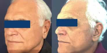 Facelift Colombia - Premium Care Plastic Surgery