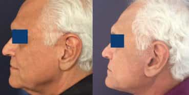 Facelift Colombia - Premium Care Plastic Surgery