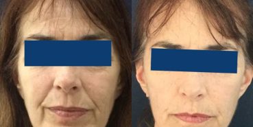 Facelift Colombia - Premium Care Plastic Surgery