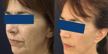 Facelift Colombia - Premium Care Plastic Surgery