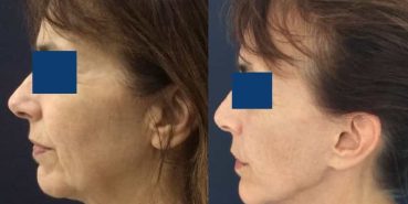 Facelift Colombia - Premium Care Plastic Surgery