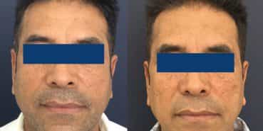 Facelift Colombia - Premium Care Plastic Surgery