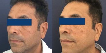 Facelift Colombia - Premium Care Plastic Surgery