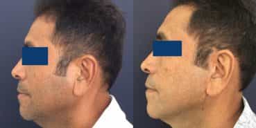 Facelift Colombia - Premium Care Plastic Surgery