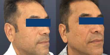 Facelift Colombia - Premium Care Plastic Surgery