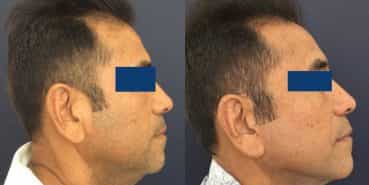 Facelift Colombia - Premium Care Plastic Surgery