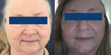 Facelift Colombia - Premium Care Plastic Surgery