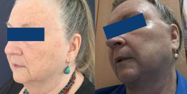 Facelift Colombia - Premium Care Plastic Surgery