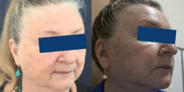 Facelift Colombia - Premium Care Plastic Surgery