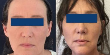 Facelift Colombia - Premium Care Plastic Surgery