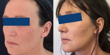 Facelift Colombia - Premium Care Plastic Surgery