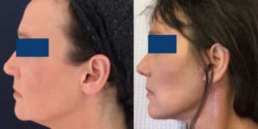 Facelift Colombia - Premium Care Plastic Surgery