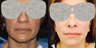 Facelift Colombia - Premium Care Plastic Surgery