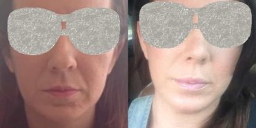 Facelift Colombia - Premium Care Plastic Surgery