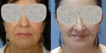 Facelift Colombia - Premium Care Plastic Surgery