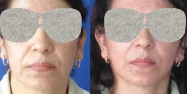 Facelift Colombia - Premium Care Plastic Surgery