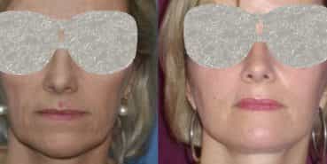 Before and After Facelift Colombia - Premium Care Plastic Surgery