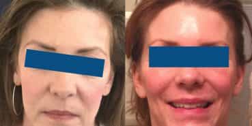 Facelift Colombia - Premium Care Plastic Surgery