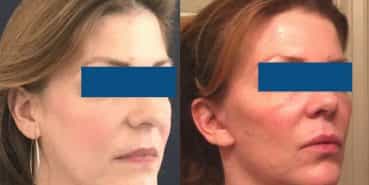 Facelift Colombia - Premium Care Plastic Surgery