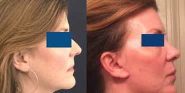 Facelift Colombia - Premium Care Plastic Surgery