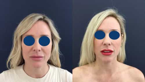 Before and after Facial Fat Grafting Colombia - Premium Care Plastic Surgery