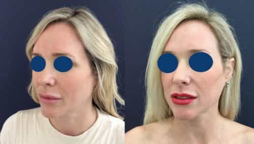 Before and after Facial Fat Grafting Colombia - Premium Care Plastic Surgery