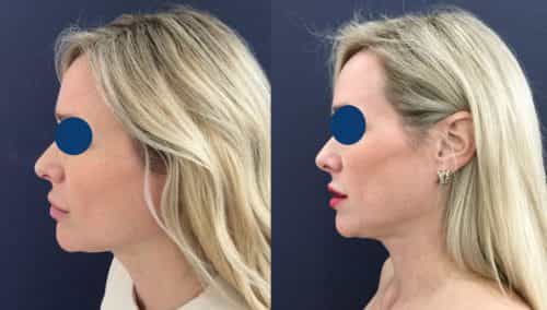 Before and after Facial Fat Grafting Colombia - Premium Care Plastic Surgery