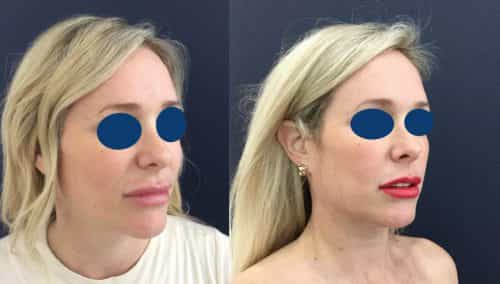 Before and after Facial Fat Grafting Colombia - Premium Care Plastic Surgery