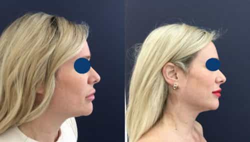 Before and after Facial Fat Grafting Colombia - Premium Care Plastic SurgeryFacial Fat Grafting Cartagena Colombia - Premium Care Plastic Surgery